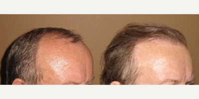 Man treated with Hair Transplant - Neograft FUE hair transplantation . Before and after Neograft hair transplantation using FUE technique without conspicous linear scar