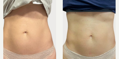 truFlex - It is a personalized muscle sculpting treatment that adjusts to your fitness level, shape and goals.