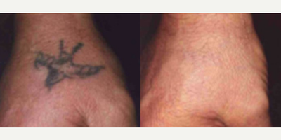 Woman treated with PicoWay - Woman treated with PicoWay