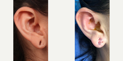 Woman treated with Earlobe Surgery - Woman treated with Earlobe Surgery
