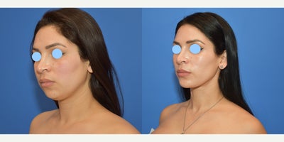 25-34 year old woman treated with Neck Lift, Chin Liposuction - Women treated with Neck lift and chin liposuction