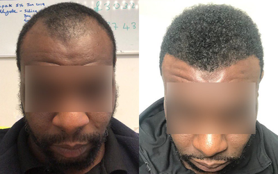 Man treated with Hair Transplant - Man treated with Hair Transplant with 2,500 grafts, shown 5 months post op.