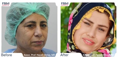 45-54 year old woman treated with Deep Plane Facelift, Facelift, Eyelid Surgery, Lip Lift, Facial Fat Transfer - 45-54 year old woman treated with Deep Plane Facelift, Facelift, Eyelid Surgery, Lip Lift, Facial Fat Transfer