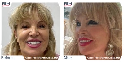 55-64 year old woman treated with Deep Plane Facelift, Facelift, Facial Fat Transfer - Treated with Deep Plane Facelift, Facelift, Facial Fat Transfer