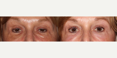 55-64 year old woman treated with ProFractional Laser - Profractional of the eyes