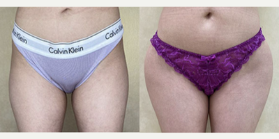 Woman treated with Hip Augmentation - Woman treated with Hip Augmentation using implants