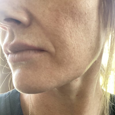 Micro Needling Has Ruined My Skin Texture And Elasticity