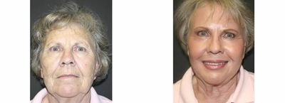 Phenol Peel - 73 Year Old Female - Phenol Peel