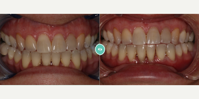 Person treated with Pinhole Gum Surgery - Person treated with Pinhole Gum Surgery