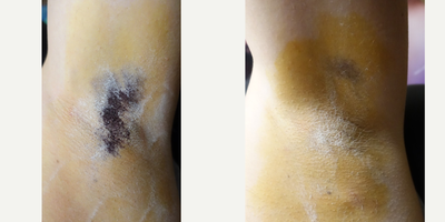 35-44 year old woman treated with miraDry - Patient iodine starch test shown before and 2 weeks after miraDry treatment.An iodine solution is applied to the skin and allowed to air-dry. Then dry the area is dusted with cornstarch. When sweat reaches the surface of the skin the starch and iodine combine causing a dramatic color change (yellow -&gt; dark blue) allowing sweat production to be actively visualized.