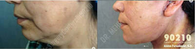 Woman treated with Neck Lift - Woman treated with Neck Lift