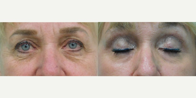 60+ year old woman treated with Fractional Laser - This patient was unhappy with the severe wrinkling under her eyelids. After examination and discussion of all options, we decided together to perform a fractionated CO2 laser treatment in our office under local anesthesia. After just one treatment there is noticeable improvement the wrinkles underneath her eyes.