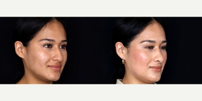 25 year old woman treated with Septoplasty, Rhinoplasty, Dermabrasion - 25 year old woman treated with Septoplasty, Rhinoplasty, Dermabrasion. Photos depict before and 2 months after surgery