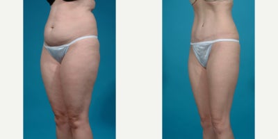 25-34 year old woman treated with Abdominal Etching, Diastasis Recti Repair, Drainless Tummy Tuck, Liposculpture, Liposuction, M - Standard tummy tuck with VASER ultrasound liposuction 360 and corset muscle plication.