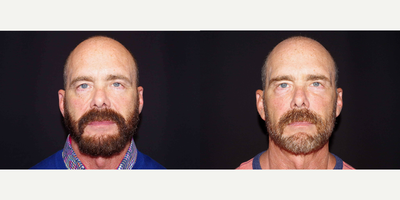 55-64 year old man treated with Bellafill - 62 year old male received 4 syringes of Bellafill to the mid-face; photos depict the patient's results 4 months post-treatment.