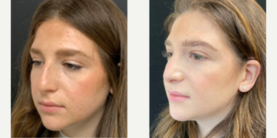 Woman treated with Rhinoplasty - Rhinoplasty