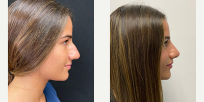 Woman treated with Rhinoplasty - Rhinoplasty
