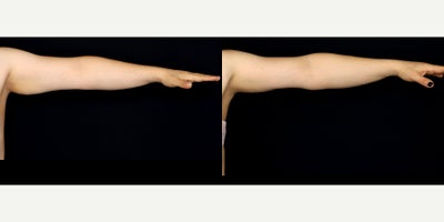 42 year old woman treated with Arm Lift - 42 year old woman treated with Arm Lift (brachioplasty) Photos depict before and 6 months after surgery.
