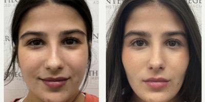 18-24 year old woman treated with Buccal Fat Removal - Young woman in her 20's treated with buccal fat removal