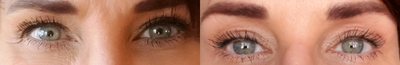 45-54 year old woman treated with Plasma Pen Fibroblast Treatment - Plasma pen brow and lid lift. Before and 2 weeks post.