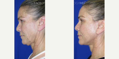 Woman treated with CO2 Laser, Facial, Neck Lift - This patient came to our office seeking facial and skin rejuvenation to reverse signs of aging.To achieve her goals, we performed our signature FaceologyLIFT which was effective in sculpting her jawline, lifting her neck, and tightening her skin. After her procedure, she underwent CO2 Laser Resurfacing to reduce the appearace of sun damage and deep wrinkles while enhancing her overall complexion.