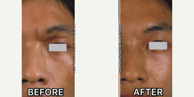 Woman treated with Pulsed Dye Laser - Oftentimes, a scar will need treatment with more than just one type of laser to get the best result. . . each laser targeting a specific part of the scar. With scars like the one pictured here, the best treatment plan involves treating not only the texture of the scar, but also the redness as well as the hyperpigmentation (excess brown color).