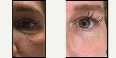 45-54 year old woman treated with MiXto Laser - The MiXto SX is a cutting-edge laser skin treatment that decreases sun damage, wrinkles, crepey skin, acne scars and tightens the skin, all with a more acceptable amount of downtime.