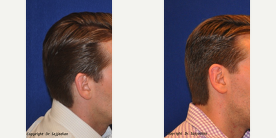 Ear Surgery - Ear Surgery