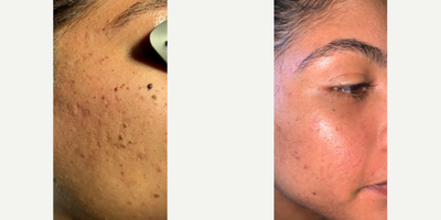Woman treated with MiXto Laser, Venus Viva - Details - Acne treated with lasers and fillers