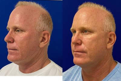 52 year old man treated with FUE Hair Transplant - My 52 year old patient 7 months post FUE hair transplant. Patient receive approximately 2,000 grafts.