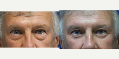 Bilateral secondary TC Lower Blepharoplasty - Bilateral secondary TC lower lid blepharoplasty with fat grafts to the face
