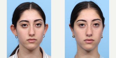 18-24 year old woman treated with Ear Surgery - Seeking to pin back her ears, this 18-year-old patient sought out Dr. Wise for an otoplasty ear-pinning procedure. Just 2 short months after surgery, her ears have healed nicely and naturally. You would never be able to tell she got anything done!