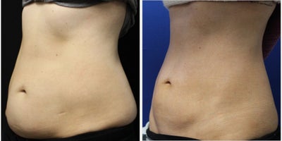 35-44 year old woman treated with CoolSculpting Elite - 35-44 year old woman treated with CoolSculpting Elite