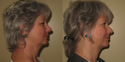 45-54 year old woman treated with FaceTite - 6 month post-op from Facetite to lower face and neck