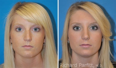 Lip Augmentation (AlloDerm) - small - 	AlloDerm implant was places in both upper and lower lips to create a small volume change that resulted in a balanced mouth. In the full face photo you are seeing the results of Rhinoplasty, and Lower Blepharoplasty fat pad removal in combination with the Lip Augmentation results.