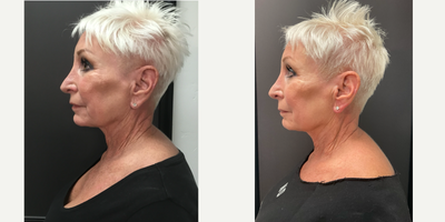 65-74 year old woman treated with Potenza - Astounding resulting from micro needling with RF with Exosomes.