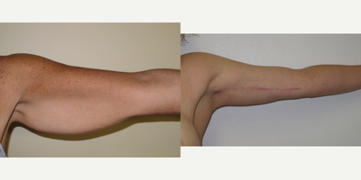 55-64 year old woman treated with Arm Lift - Brachioplasty - Arm lift
