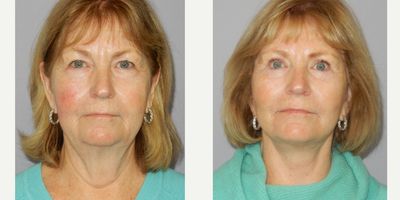 65-74 year old woman treated with Facelift, MACS Facelift, Eyelid Surgery - 68 yo lady requesting facial rejuvenation for marked signs of ageing. Modified MACS facelift, upper and lower blepharoplasty and eyelid ptosis repair.Dr Damien Grinsell Registered medical practitioner, specialist plastic surgeon(Speciality registration in surgery - plastic surgery)AHPRA Registration: MED0001207555Any invasive procedure carries risks and individual results may vary depending on genetic factors, not limited to but including age, genetics, diet, lifestyle and existing medical conditions. Outcomes shown are only relevant to this patient and do not necessarily reflect the results other patients may experience. Before any surgery, we recommend you consult a qualified health practitioner who should discuss at length these risks, including possible outcomes and recovery/aftercare instructions specific to your procedure. If unsure, always seek a second opinion from a specialist plastic surgeon.