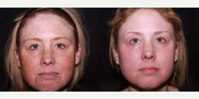 Laser Resurfacing - Laser Resurfacing