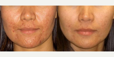 Woman treated with Laser Genesis - Genesis Laser Treatments for Acne