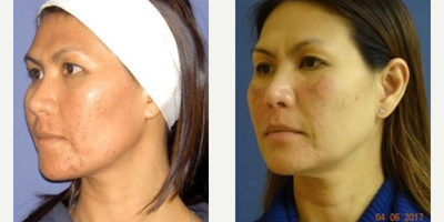 Woman treated with Laser Genesis - Genesis for Acne Treatment
