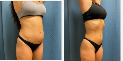 25-34 year old woman treated with Emsculpt - Emsculpt