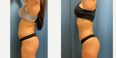 25-34 year old woman treated with Emsculpt - Emsculpt