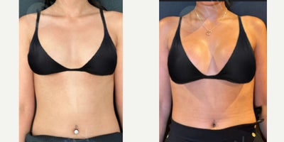 35-44 year old woman treated with Breast Augmentation - Breast augmentation performed to enhance volume and improve proportion. Implants were placed to achieve a fuller yet natural contour.
