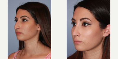 Woman treated with Nose Surgery - Woman treated with Nose Surgery