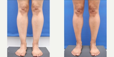 45-54 year old woman treated with Liposuction, Laser Liposuction, Tumescent Liposuction, Power-Assisted Liposuction (PAL), Calf  - Before and 7 months after Precision Sculpt awake liposuction or Ankles and Calves.