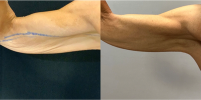 45-54 year old woman treated with Renuvion - Renuvion.