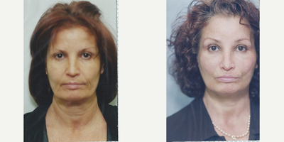 57 year old woman-Thread Lift - Patient was treated with Thread Lift to soften NL folds around the mouth, and to lift jowls and define cheeks.&nbsp;