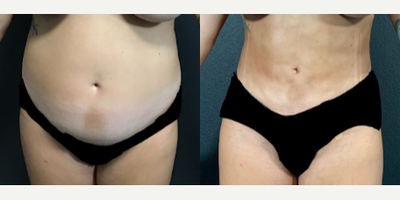 Woman treated with Vaser Liposuction - Woman treated with Vaser Liposuction- 6 weeks post-op