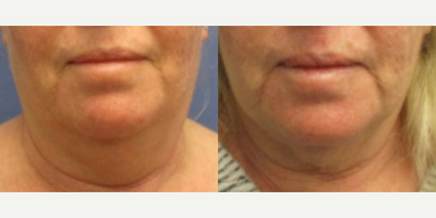 55-64 year old woman treated with Kybella - 59 year old female before, 18 months after 2cc of Kybella injections to submental area.